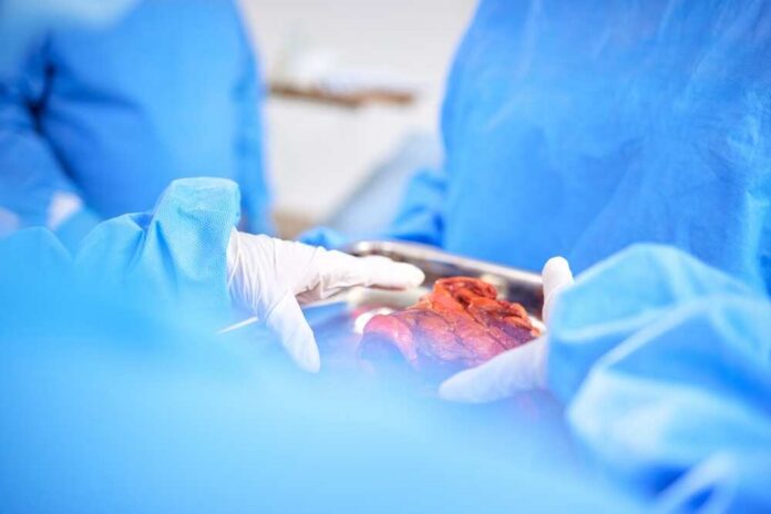 Organ,Transplant,,Hands,And,Doctor,Surgery,,Medical,Support,Or,Teamwork Surgeons in blue scrubs handling an organ during surgery